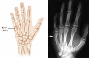 Boxers Fracture
